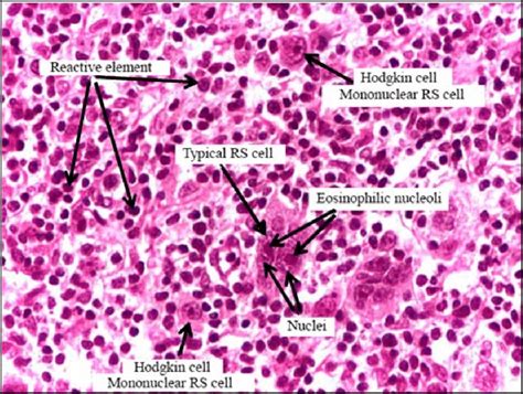 reed-sternberg cells|reed sternberg cell function.